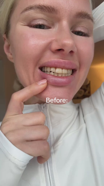 Professional Whitening Kit – Immediate &amp; Long-Lasting Whitening Effect ⭐️🏅